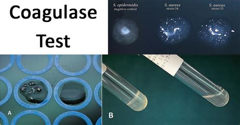 coagulase test results|Coagulase Test: Principle, Procedure, Results • Microbe Online.